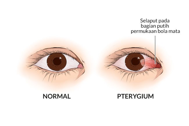 Tips Cegah Pterygium Pada Mata