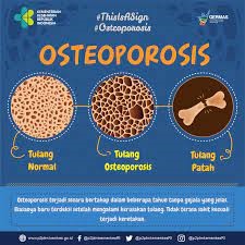 Yuk, Simak Pencegahan Osteoporosis
